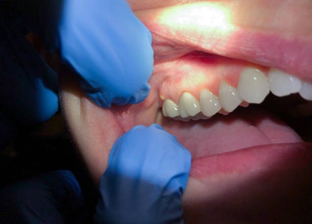 Best Emergency Tooth Extraction in Kent City, MI